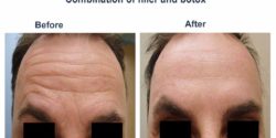 Combination of filler and botox