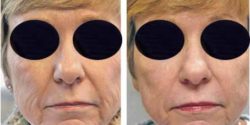 Wrinkle reduction by CO2 LAser